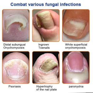 KUBOZN™ Bee Venom Nail Fungus Treatment Solution