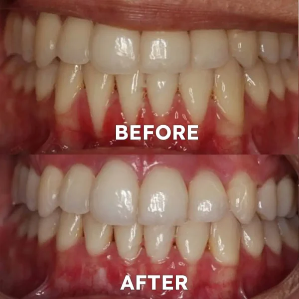 Ourlyard™ Teeth Restoration Mineral Powder